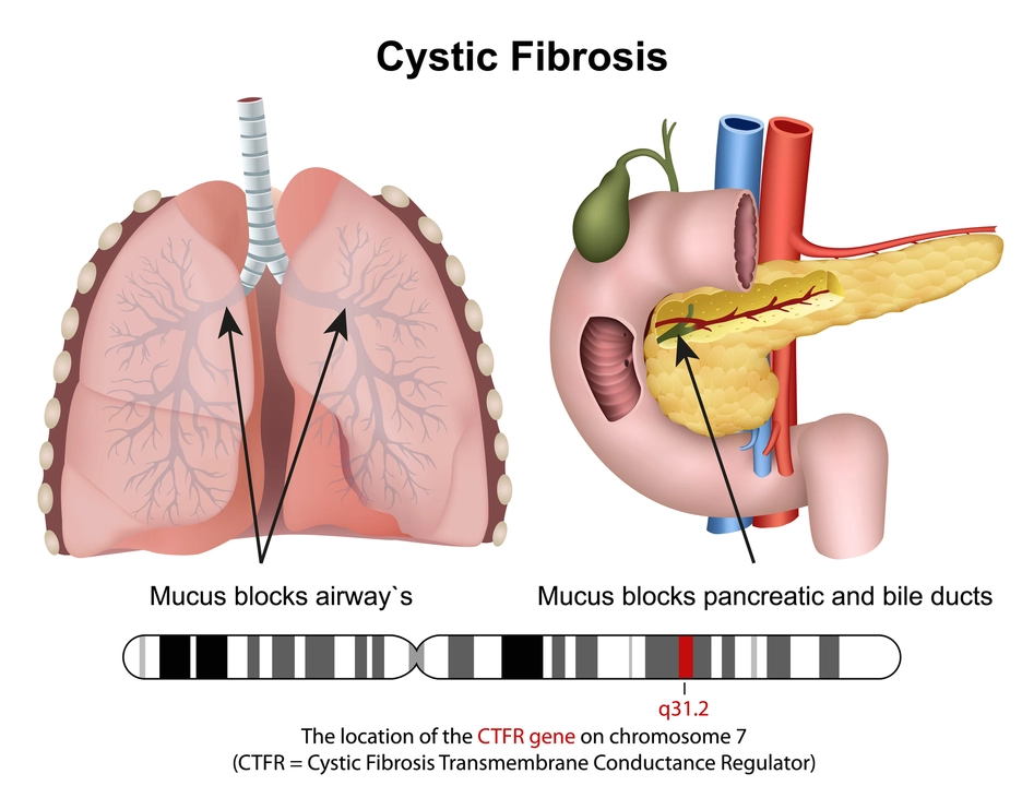 The Connection Between Cystic Fibrosis and Sinusitis