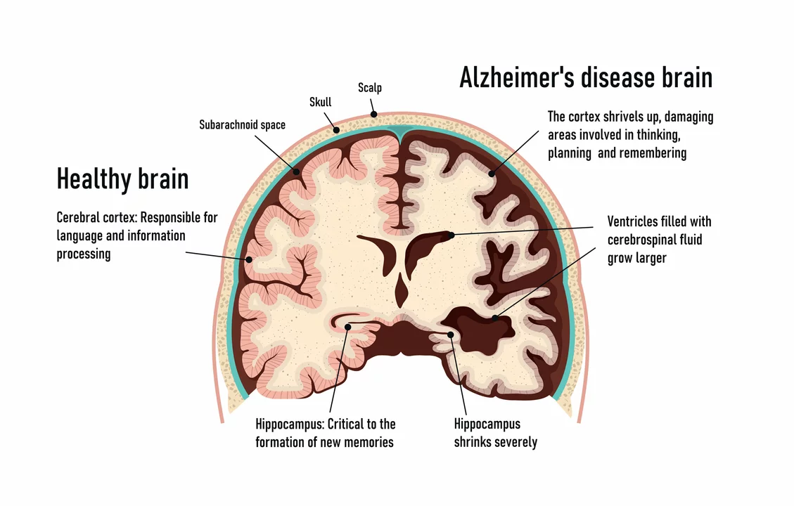 The Role of Nutrition and Rivastigmine in Alzheimer's Disease Management