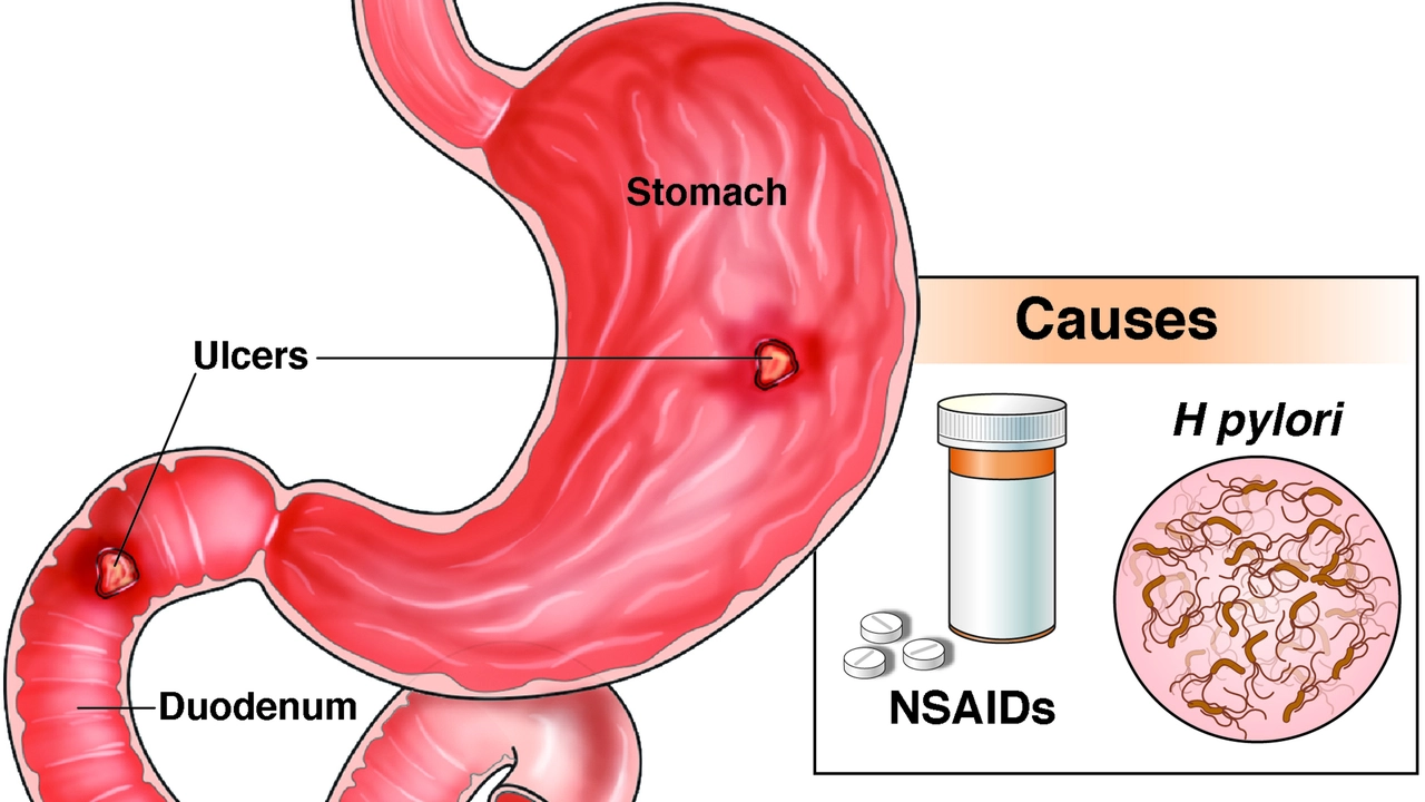The Importance of Early Diagnosis and Treatment for Stomach Ulcers